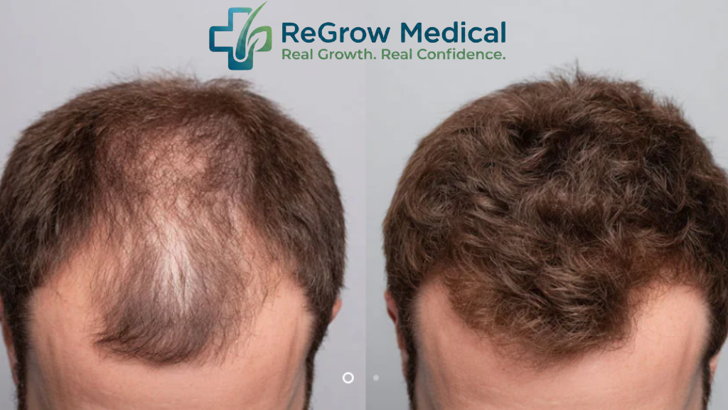 ReGrow Medical – Hair Restoration & Transplants gallery photo