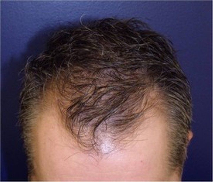 Chesapeake Hair Restoration – Hair Transplants in Baltimore, Maryland gallery photo