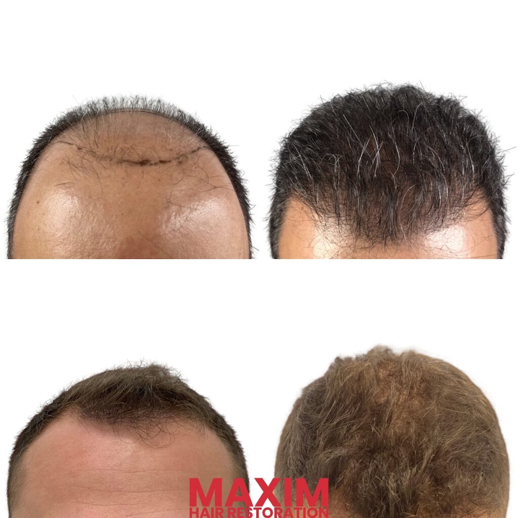 Maxim Hair Restoration & Transplants – Boca Raton gallery photo