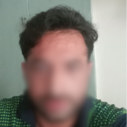 Hair Transplant Islamabad – Hairhub gallery photo
