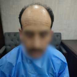 Hair Transplant Islamabad – Hairhub gallery photo