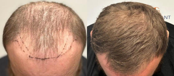 HTG Hair Transplant Group North London gallery photo