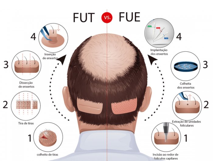 Dr. Bruno Frauches – Transplante capilar FUE gallery photo