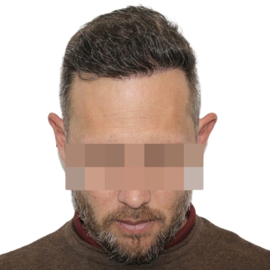 Marmedical – Trapianto Capelli Milano gallery photo