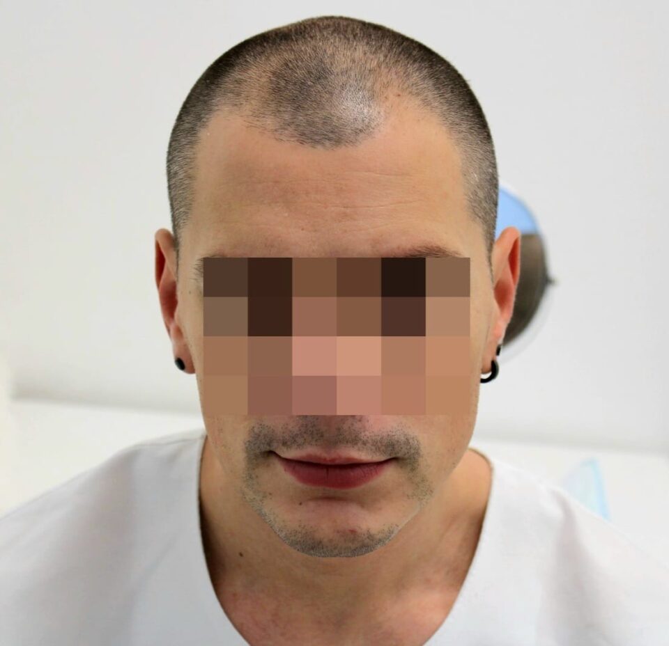 Marmedical – Trapianto Capelli Milano gallery photo