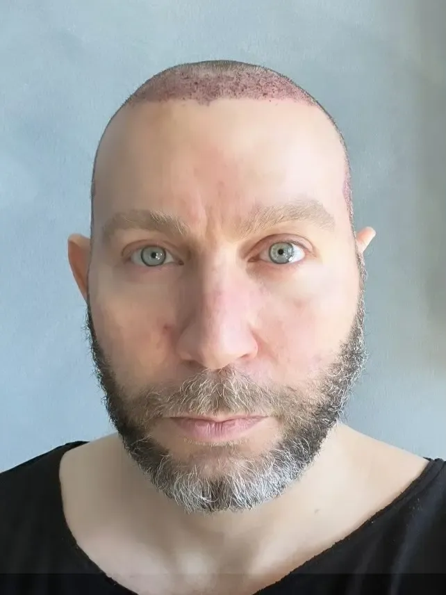 Moleno Hair Restoration gallery photo