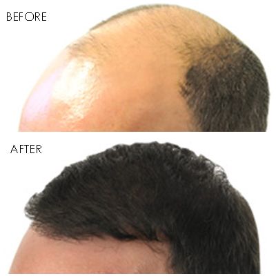 NeoGraft Hair Restoration Orange County gallery photo