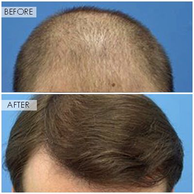 NeoGraft Hair Restoration Orange County gallery photo