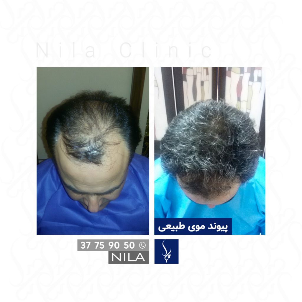 Nila Hair Transplant Clinic Isfahan gallery photo