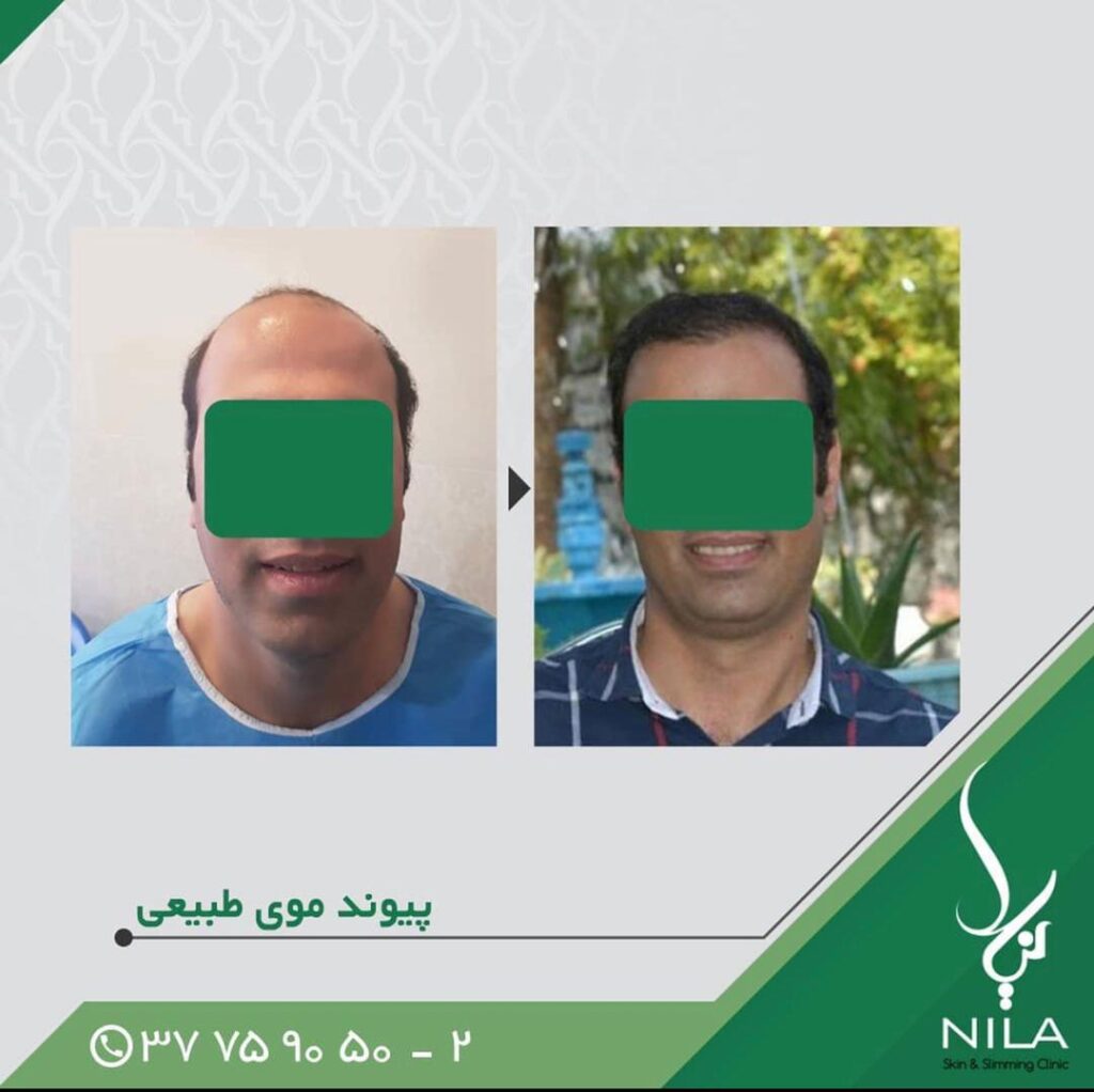 Nila Hair Transplant Clinic Isfahan gallery photo