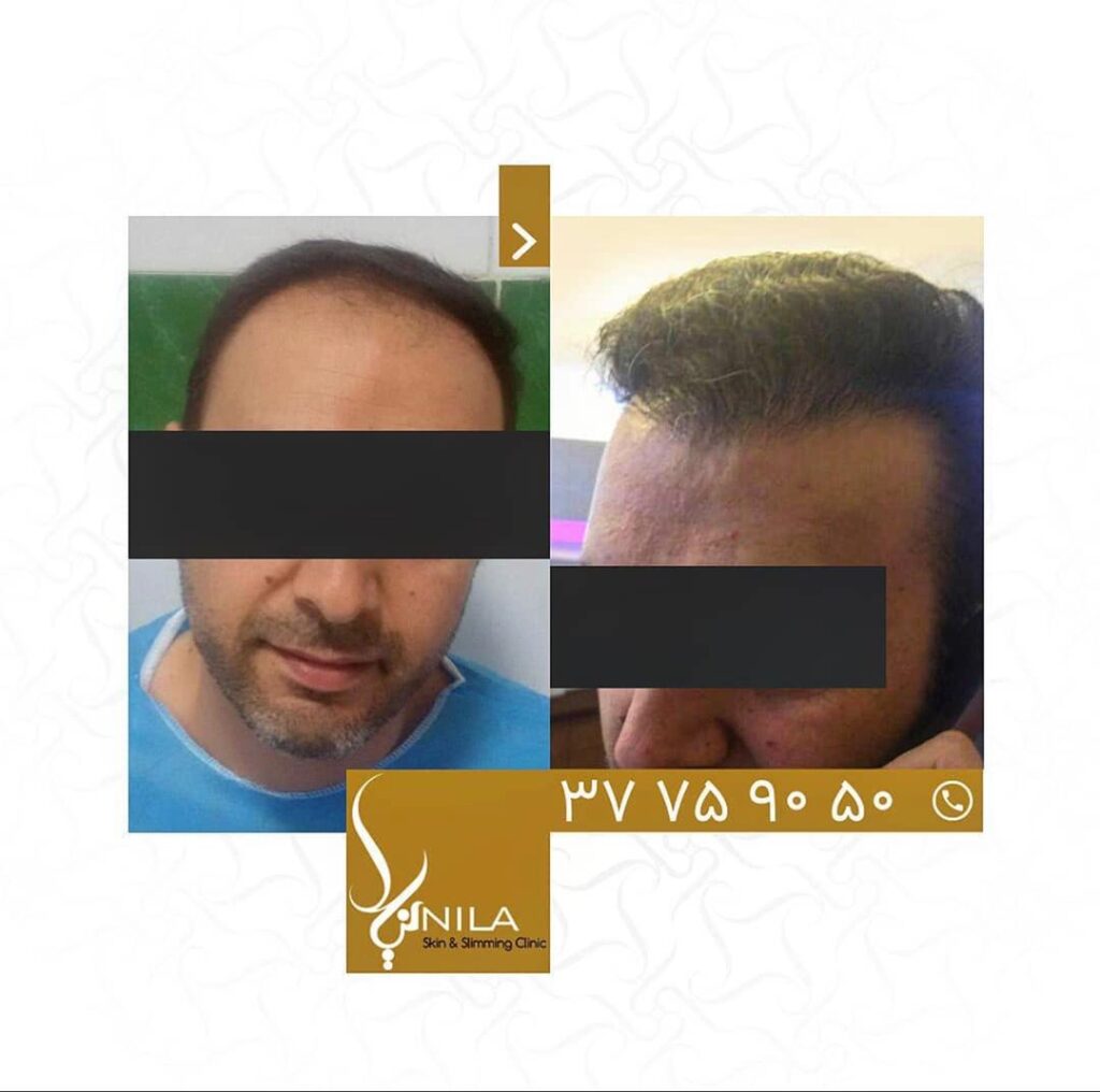 Nila Hair Transplant Clinic Isfahan gallery photo