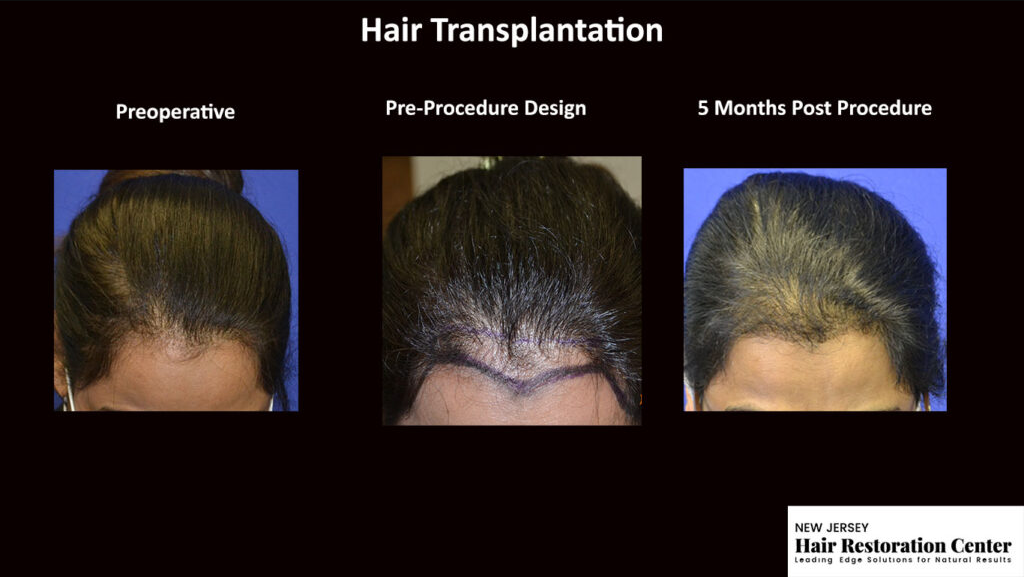 New Jersey Hair Restoration Center gallery photo