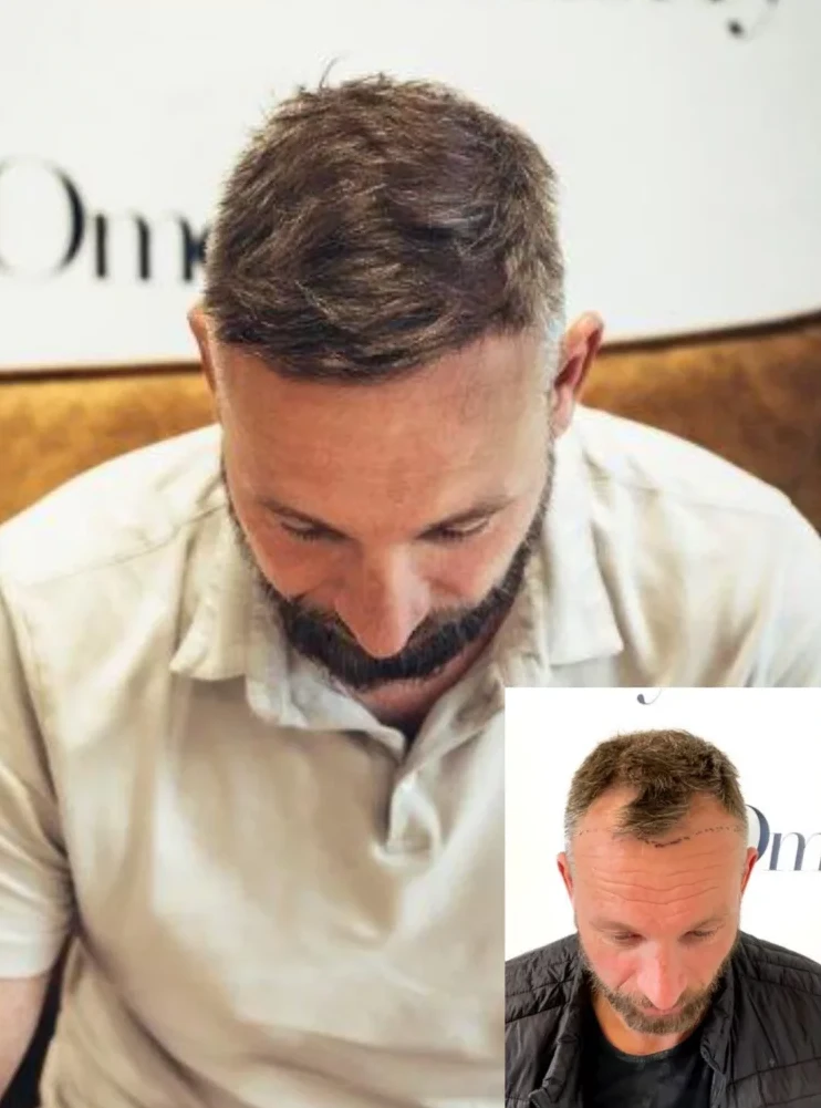 Omorfy Haartransplantatiekliniek Maarn gallery photo