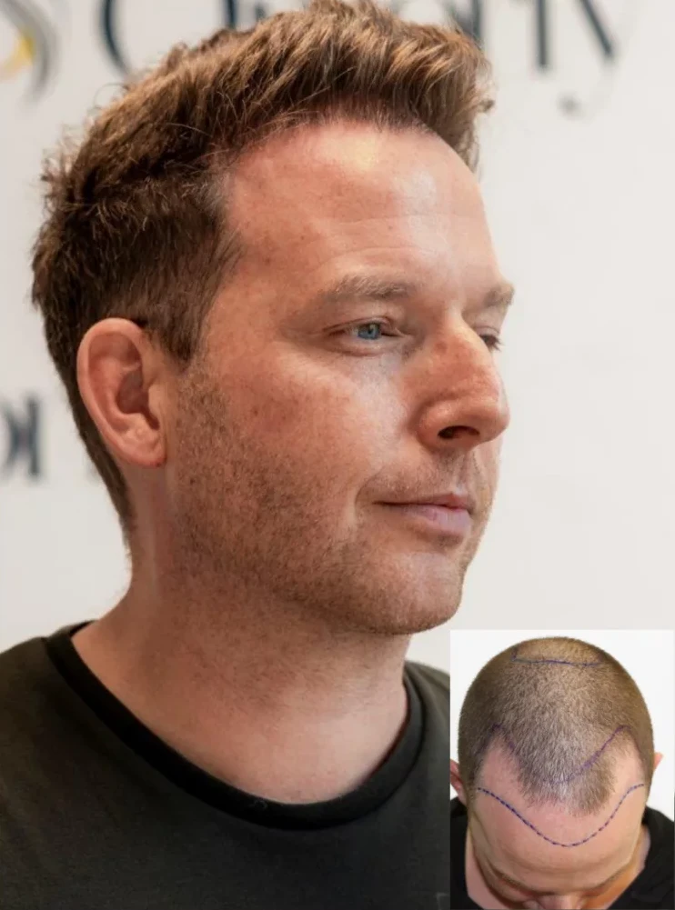 Omorfy Haartransplantatiekliniek Maarn gallery photo