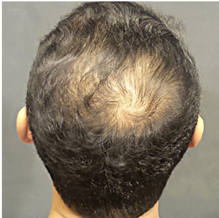 Hair Restoration Seattle – Dr. Javad Sajan gallery photo