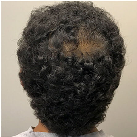 Hair Restoration Seattle – Dr. Javad Sajan gallery photo